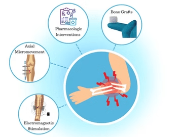Healing Broken Bones: The Latest Advances in Fracture Repair