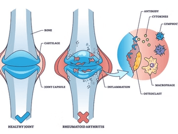 Bone-Immune System Interactions: Implications for Rheumatoid Arthritis